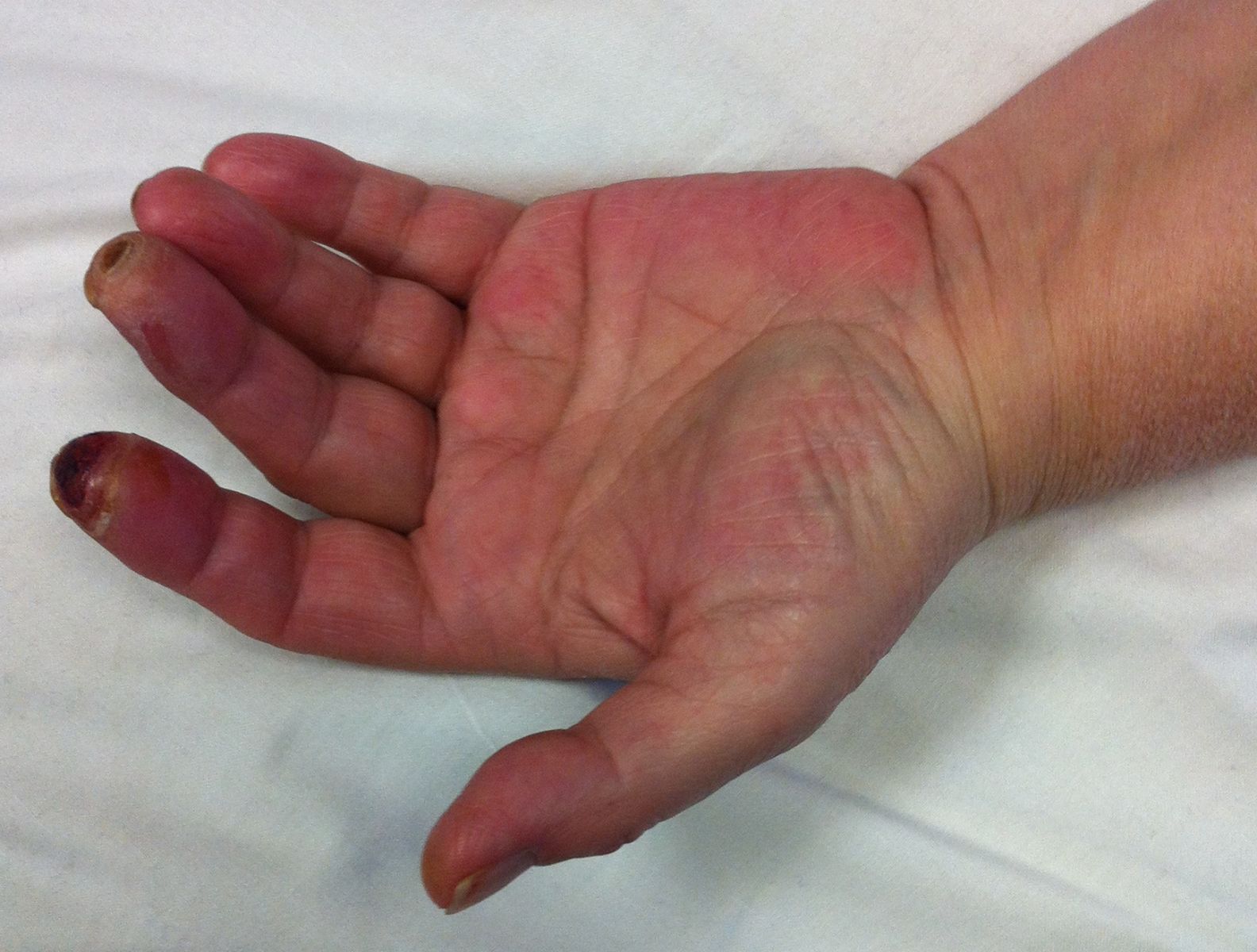 Wrist Pain And Bulging Vein at Dorothea Hunter blog